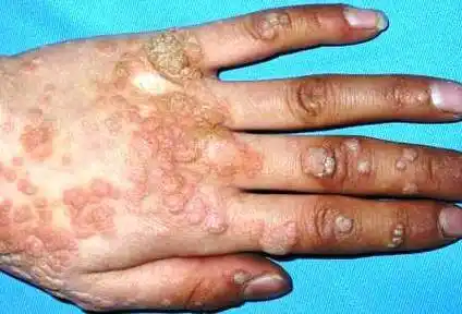 病毒疣疣的临床表现及其分型图片