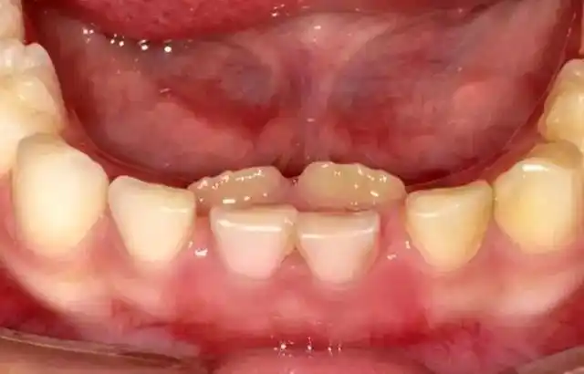 孩子长双排牙危害大,元凶不是糖,竟然是……_儿童牙病_儿童牙病相关