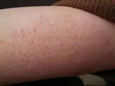 长有体癣会有哪些的症状特点