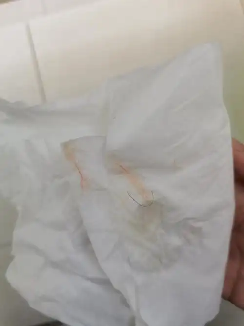 非生理期白带带血有图