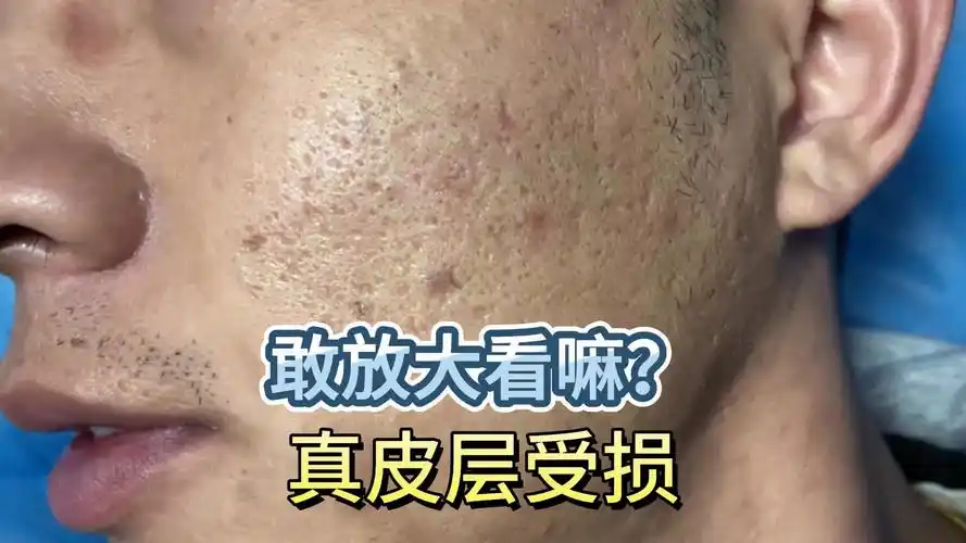 【密集痘坑】密密麻麻,真实皮肤放大看!真皮层受损,能修复啥样?