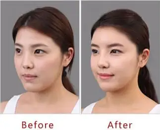 注射玻尿酸丰苹果肌手术前后效果对比图