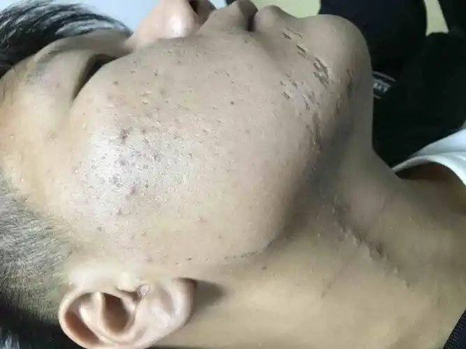 不一样的黑头粉刺