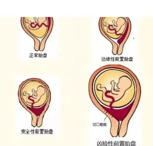 "遭遇"凶险性前置胎盘 母女危在旦夕 附属医院"最强阵容"出手了