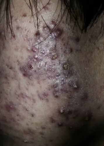 这几天脸上的痘痘又严重了,改怎么办?可以