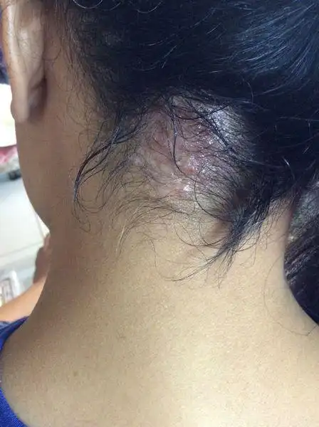 一个朋友头皮不知道为什么开始长一片像癣一样的东西,一年了,现在面积