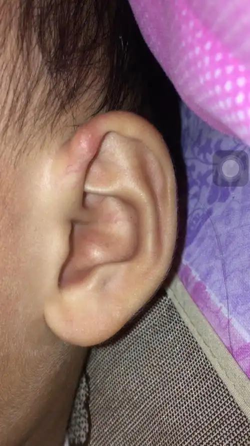 孩子耳朵上长个硬疙瘩,像骨头的感觉