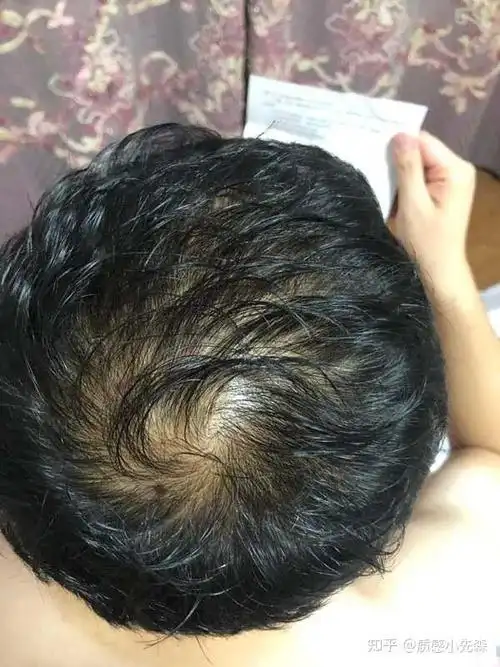 90后脱发严重怎么办