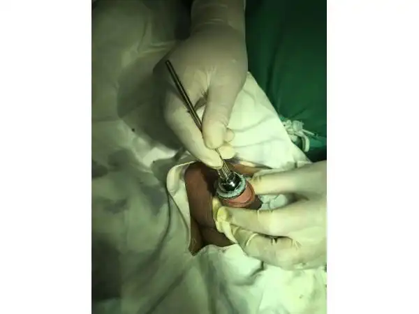 【开放式吻合器】开放式吻合器厂家-品牌-招商信息-东方医疗器械网