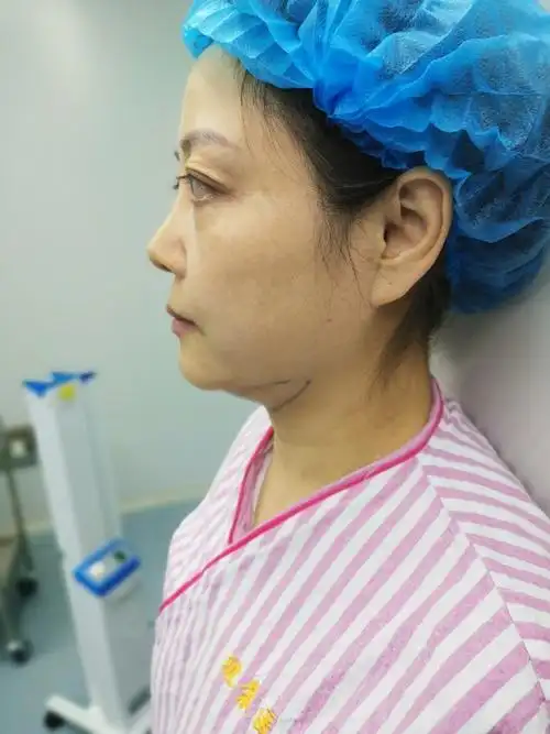 92迷你拉皮年轻化改善术后第二十五天92 94第二十五天_圈子