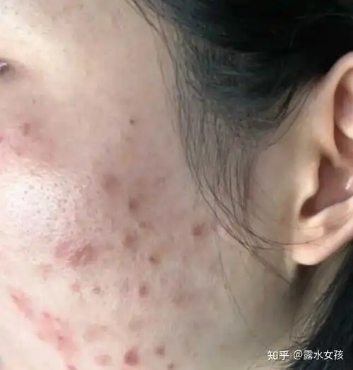 必须掌握的10个皮肤护理方法,让你用最少的钱搞定痘痘,黑头,敏感肌