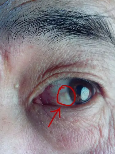 眼睛上长得半通明的东西 知道是什么吗 有图片 多谢!