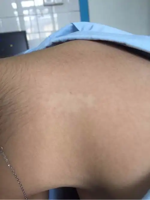 白癜风初期不会这样是吗?