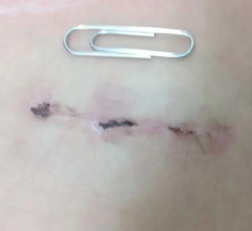 解答各位家长疑问,举例说明,这是我一例正中小切口,室缺修补手术,切口