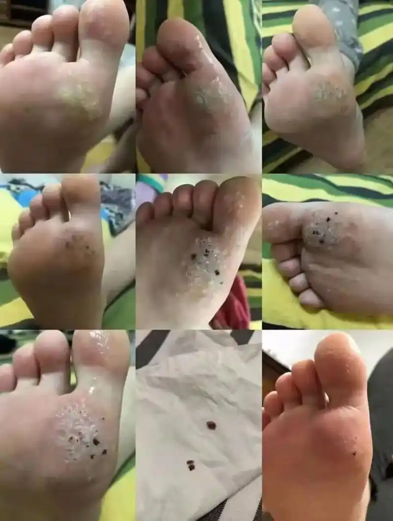 脚底长的疣反馈