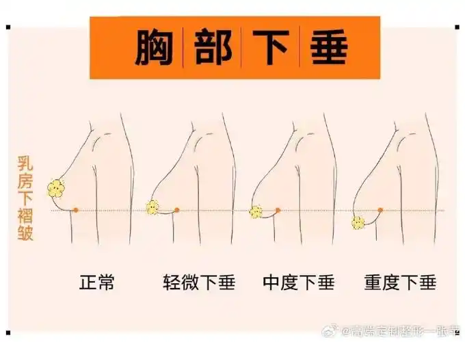 烟台曙光##医美##烟台曙光隆胸##隆胸