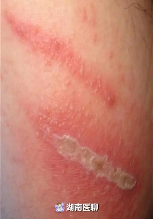 雨后闷热小心这种虫皮肤接触就遭毒素腐蚀疼痛长红疹