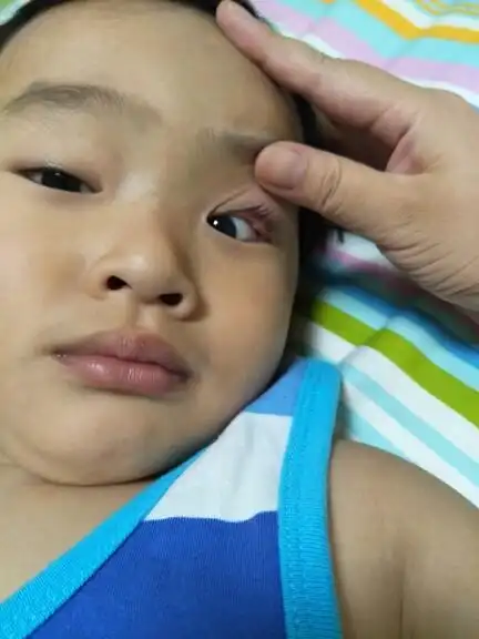 宝宝眼睑长了个红疙瘩怎么办