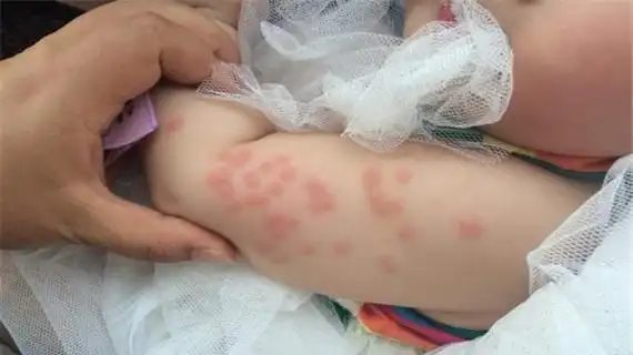 螨虫叮咬皮损图