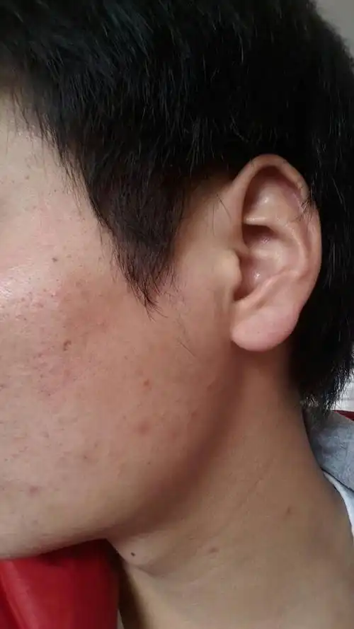 脸部毛囊炎 有时候瘙痒,带些刺痛.毛孔粗大,有黑头是硬的.