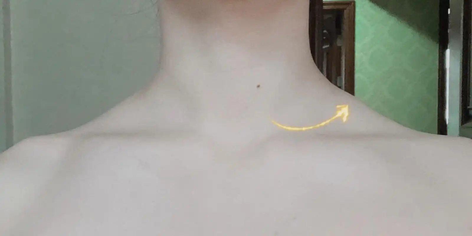 斜方肌中间鼓起来一块是什么东西啊救命 有在keep上跟练一些瘦肩缩