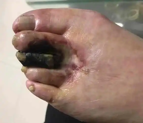 脚趾的一个小小黑疤三个月就让她面临截肢