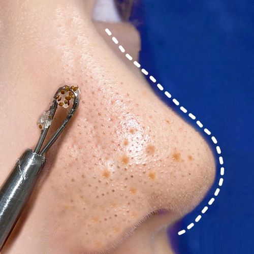 【毛孔吸尘器】清洁毛孔堵塞 深层清洁污垢 脸部脏东西统统消失