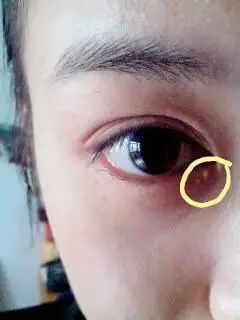 眼睛眼角外长了一个白色的小包.