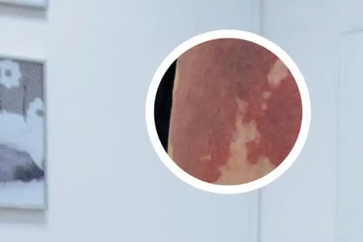 身上牛奶咖啡斑越长越多