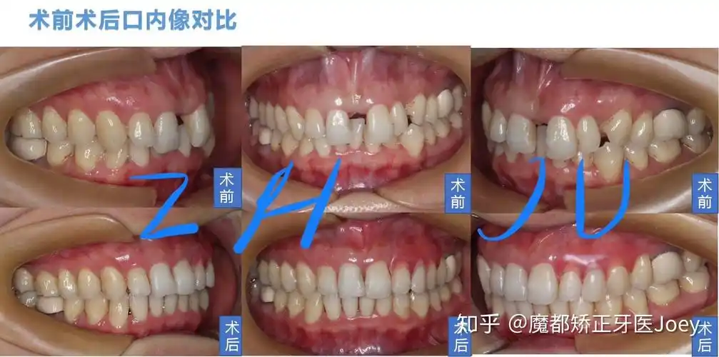 虎牙不可随便拔