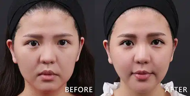 利用玻尿酸填充苹果肌(效果因个案而异)