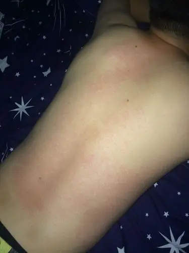 背部上突然红红一片 不痒 微微刺痛 请问是什么问题,该怎么办呐???急