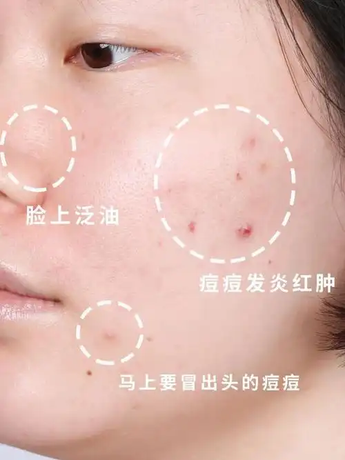 痘痘频发发红爆皮夏季肌肤问题的自救方案都在这里了