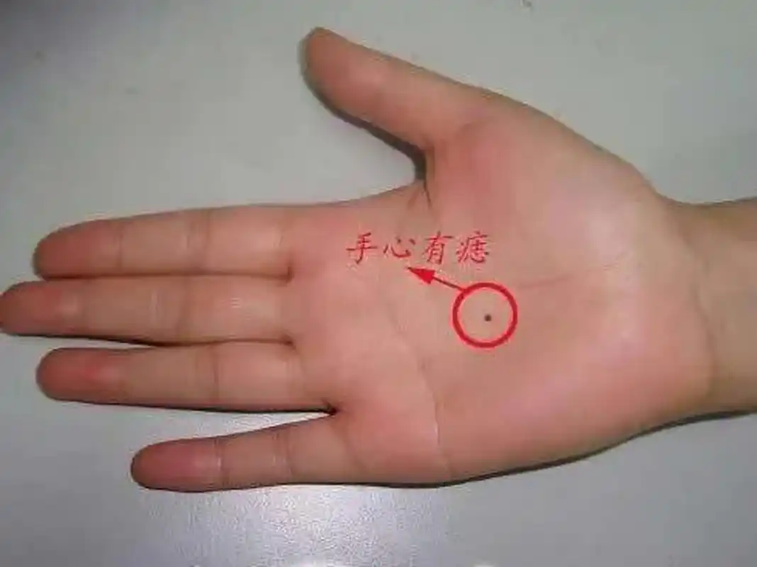 身上的痣也有好坏?如果"黑痣"长在这4个部位,多加留意