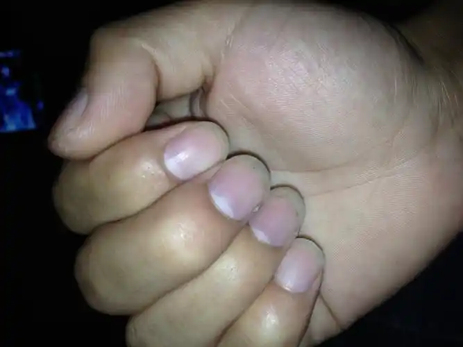 应该有一段时间了这指甲颜色感觉偏紫色害怕身体哪出现问题