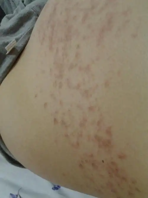 肚皮上一片一片红的,痒死了,貌似红点上有白白的