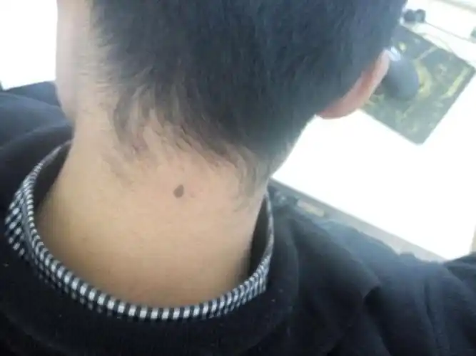 苦情痣词条图册_百度百科