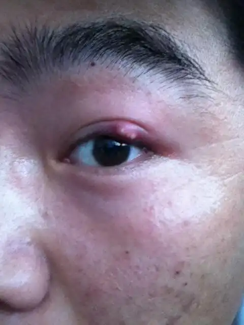 我上眼皮上长疙瘩了,半个月了