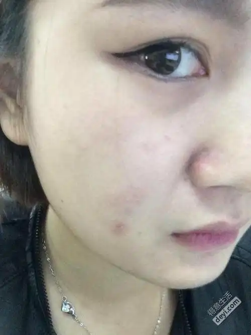 脸部严重过敏,如何维权?