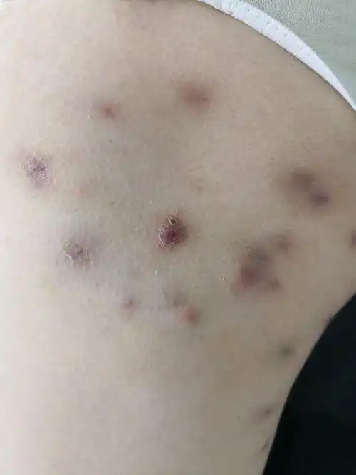 颈部腋下臀部腹股沟多发毛囊炎疤痕结节症状.印象毛囊闭锁三联.