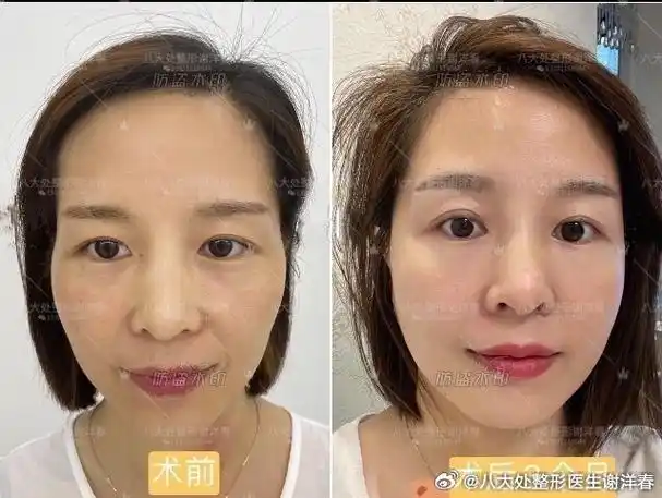 没有明显松弛下垂,但是因为面部凹凸不平导致的,脂肪填充后对比#自体