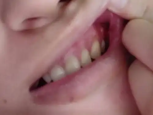 牙齿肉上长一颗硬硬的肉,是怎么回事呀?