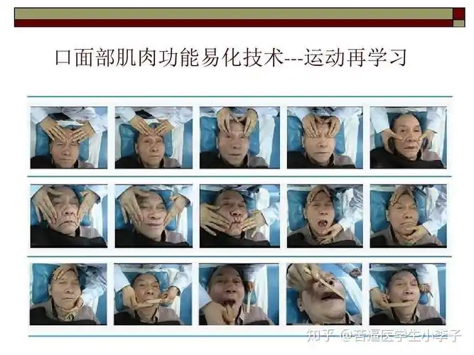 周围性面瘫治疗及恢复经验之谈