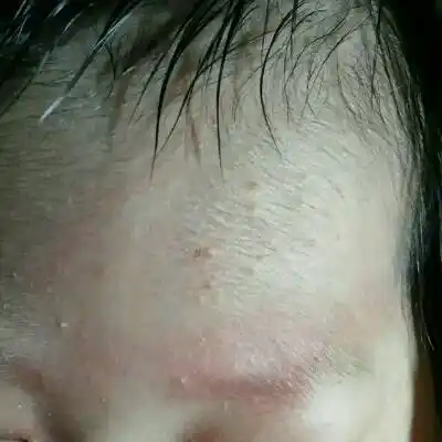 宝宝28天,脸上长了好多小疙瘩,有白头,一哭一碰到会变红,是怎么回事啊
