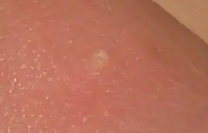 龟头上有一个白色圆环状小圈,直径一毫米,硬质,不痛不痒.时间有2年了.