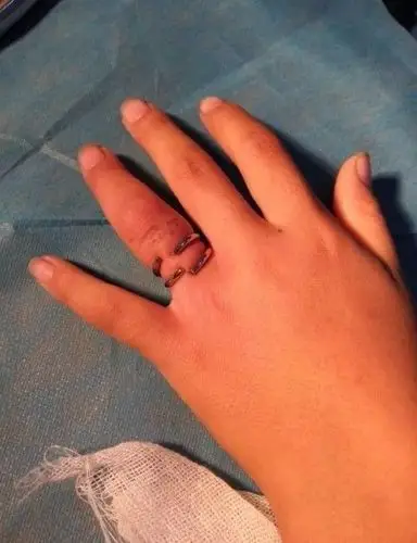 氧气快讯男孩手指套金箍面临坏死高密医生大力剪解围