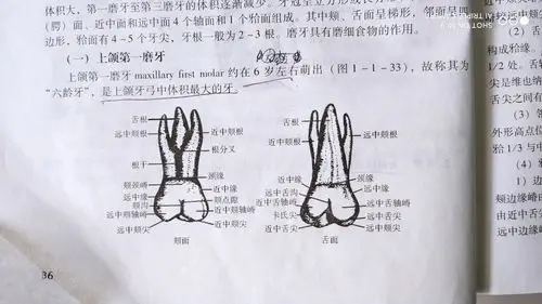 右侧上颌第一磨牙