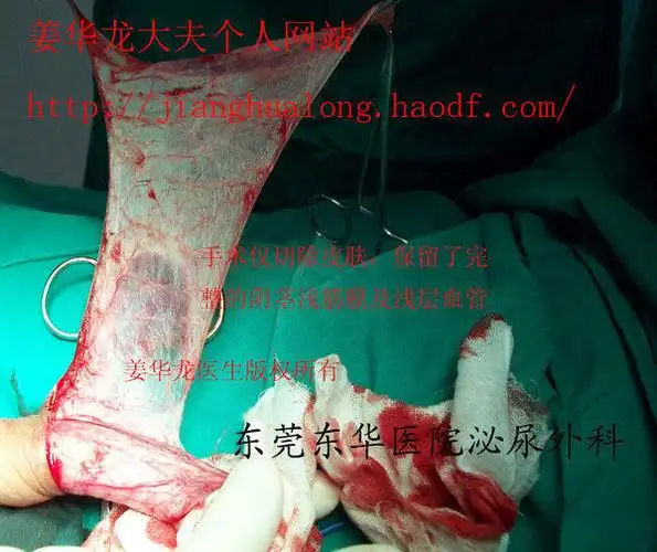 切除范围准确到时1mm,真正的精准手术,精准医疗图解袖套式包皮环