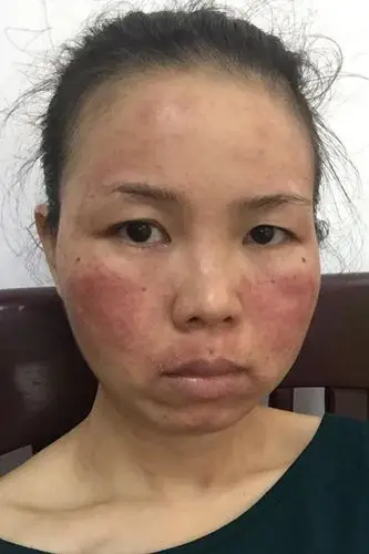 激素皮肤过敏怎么办?