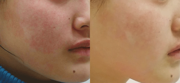 激光消除红血丝前后效果对比